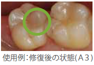 軽度着色歯にフローだけで対応可能。
